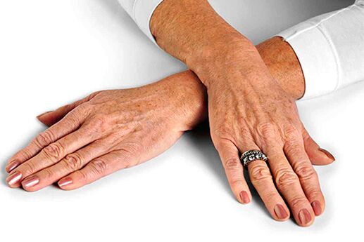 Peau des mains présentant des modifications liées à l'âge qui nécessitent l'utilisation de techniques de rajeunissement