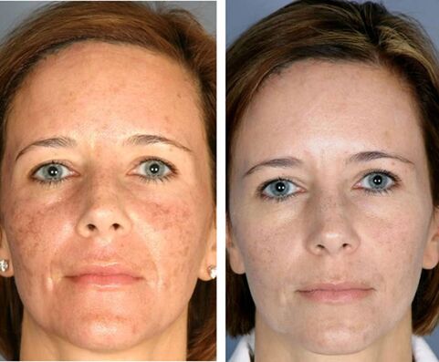 Avant et après la thermolyse fractionnée du visage