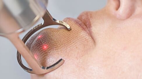 Cours de procédures pour le rajeunissement fractionné de la peau du visage au laser