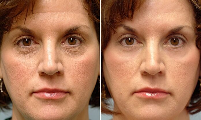 visage avant et après la re -fracture laser